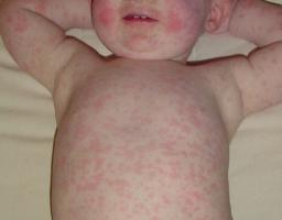 Alergická vyrážka u dětí