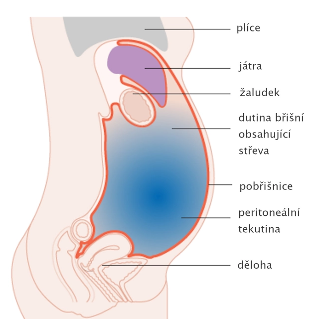 Rakovina jater a nafouklé břicho