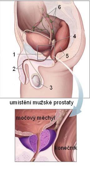 Co je to rakovina varlat?