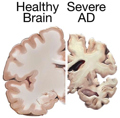 Alzheimerova choroba a další formy demence