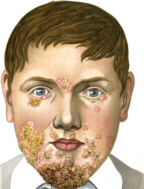 Impetigo