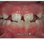 Eroze a restaurování zubní skloviny