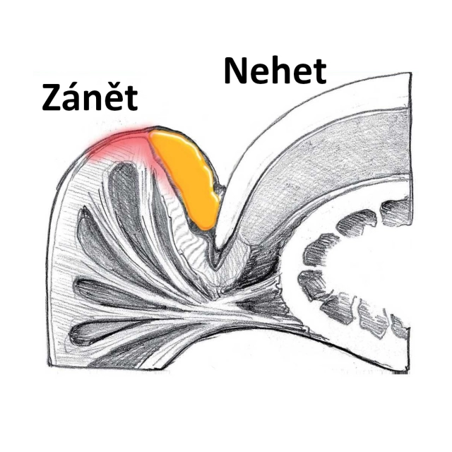 Zánět nehtového lůžka