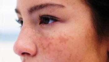 Rady na odstranění tmavých skvrn na tváři