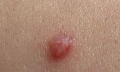 HPV virus