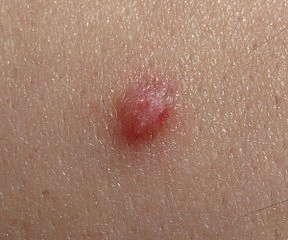 HPV virus