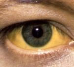 Žluté bělmo očí